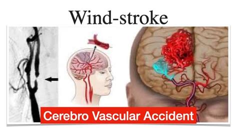 course | TCM for Wind Stroke , Paralysis , Hemiplegia