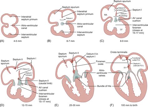Congenital heart disease: pathology, natural history, and interventions - Clinical Tree