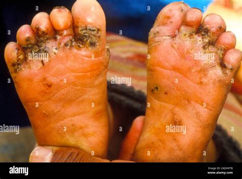 Jigger Fleas Remove 的图像结果