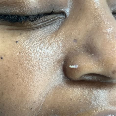 Filiform Warts: Causes and Removal Options