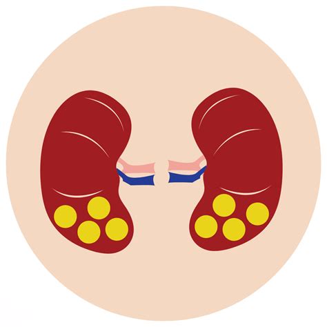 KIDNEY STONE - Causes, Symptoms & Treatments with Herbal | Ayurvedic ...