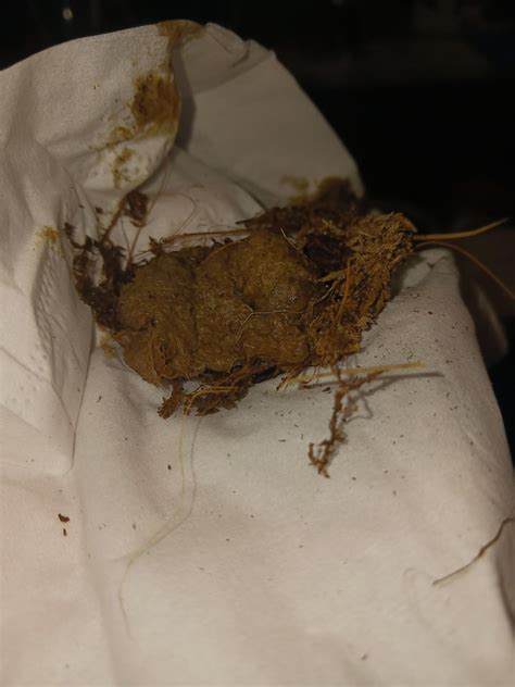 Vomiting Feces Diverticulitis Stool Pictures: Changes In Bowel