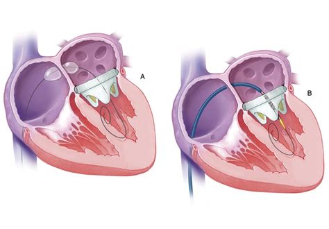 Pacemaker Procedure 的图像结果