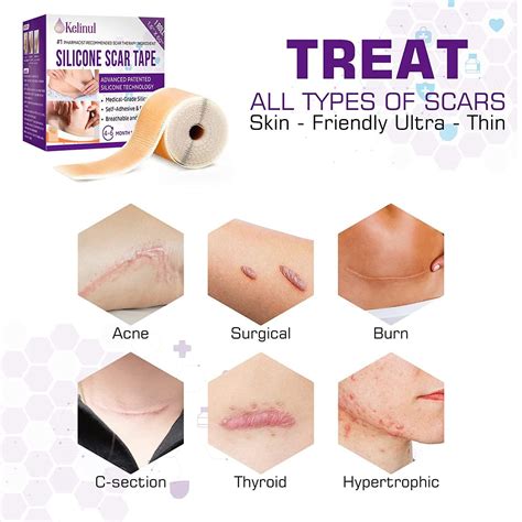 Soft Silicone Gel Scar Tape Roll 1.6'' x 60'' - Medical Grade Silicone ...
