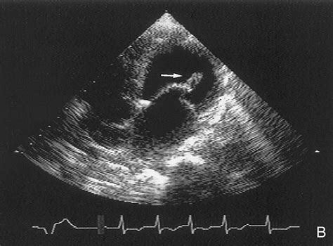 Ruptured Papillary Muscle | Circulation