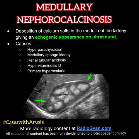 Medullary Nephrocalcinosis | Radiology, Medical ultrasound, Diagnostic ...
