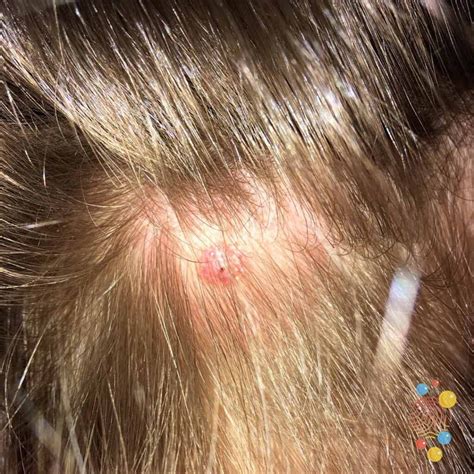 Tick bite - Skin Deep