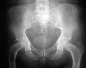 Hip Replacement: Protrusio acetabular treatment | Hip migration ...