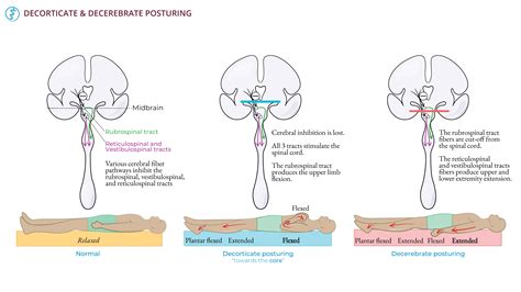 Neuroanatomy: Decorticate & Decerebrate Posturing | ditki medical ...