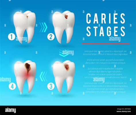 Caries Stages Different Types Of The First Permanent Molars, Including