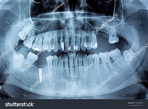 Dental Xray Periodontitis Problems Decayed Teeth 스톡 사진 370878608 ...