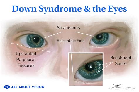Down Syndrome & the Eyes: Vision Health & Eye Conditions