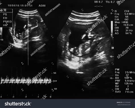 Ultrasound Film Fourteen Week Fetus Stock Photo 421959940 | Shutterstock