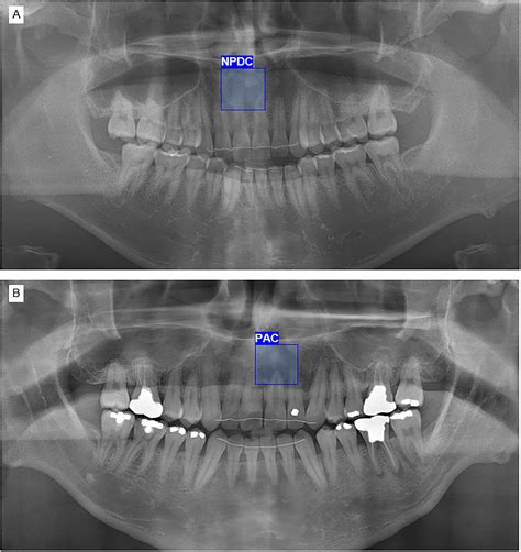 Automatic detection and classification of nasopalatine duct cyst and periapical cyst on ...