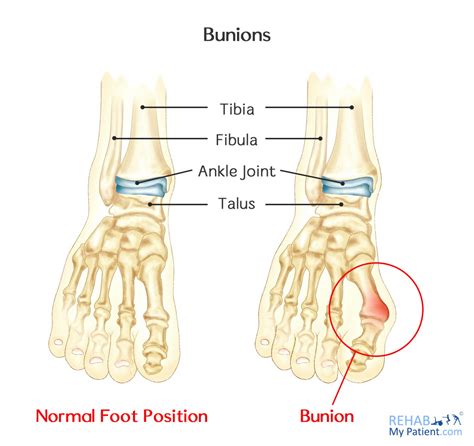 Bunions | Rehab My Patient