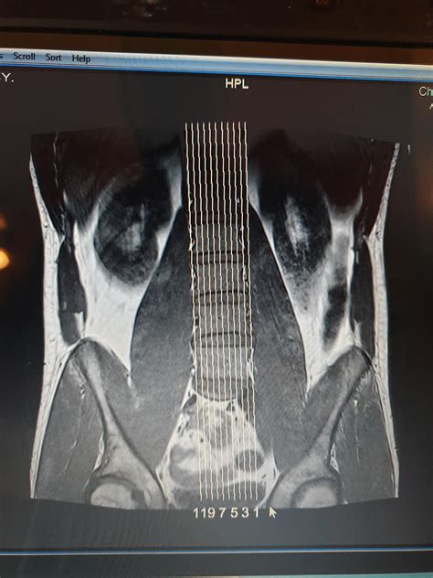 L5/S1 retrolisthesis, herniations and S1 root nerve compression : r ...