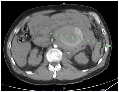 Endovascular and Open Surgical Treatment of Ruptured Splenic Artery ...