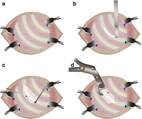 Image result for First Rib Resection Surgery