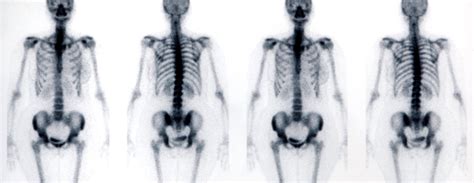 Bone Scan Testing 的图像结果