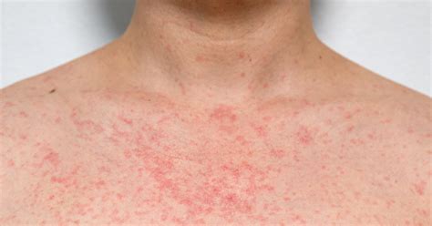 What Is Heat Rash? Dermatologists Explain the Causes | PS Beauty