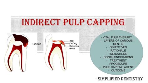 Image result for Difference Between Direct and Indirect Pulp Capping