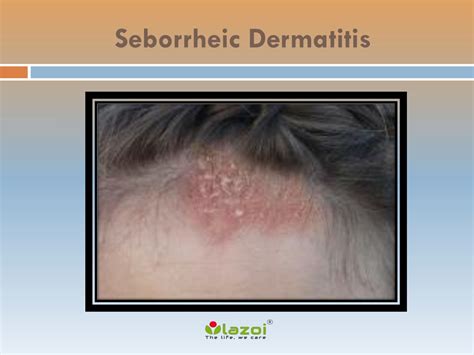 PPT - Seborrheic Dermatitis: Causes, Symptoms, and Treatment Options PowerPoint Presentation ...