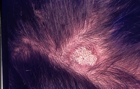 Plaque Psoriasis Scalp Hair Loss at James Auxier blog