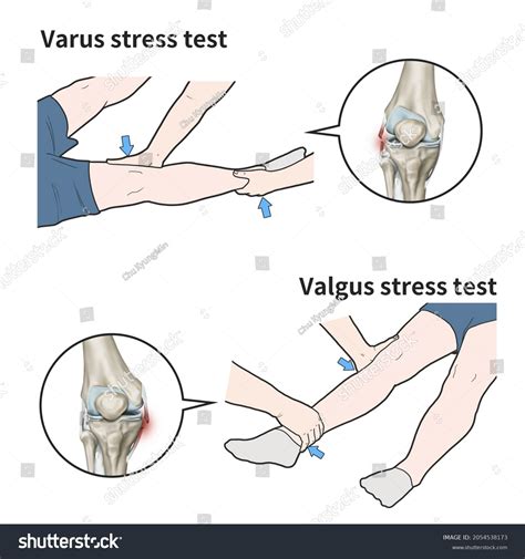 3d Medical Illustration Explain Varus Valgus: стоковая иллюстрация ...