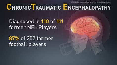 99 percent of studied brains from dead NFL players had CTE | abc10.com