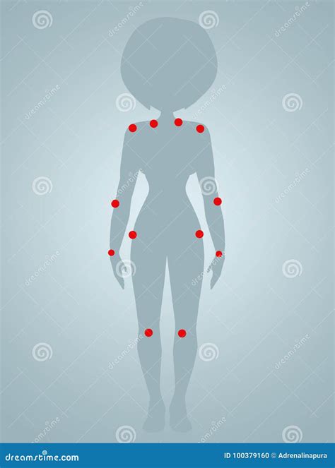 Tender Points of Fibromyalgia Stock Illustration - Illustration of points, headaches: 100379160