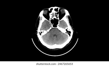 Image result for Normal Brain CT Scan Head