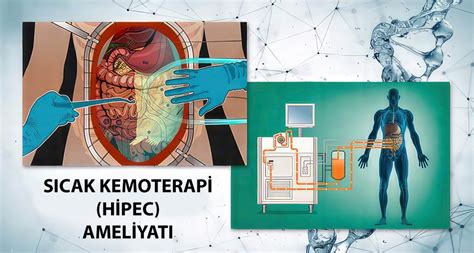 HIPEC Ameliyatı Yan Etkileri Nelerdir?