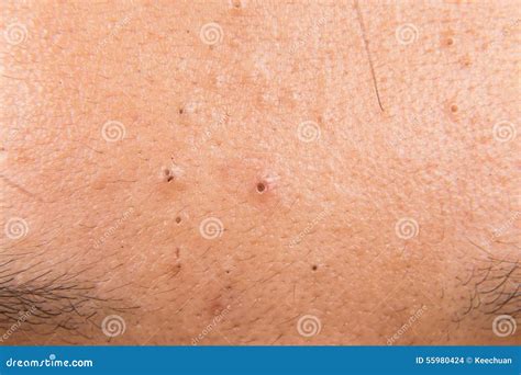 Ugly Pimples, Acne, Zit and Blackheads on the Forehead of a Teenager Stock Photo - Image of ...