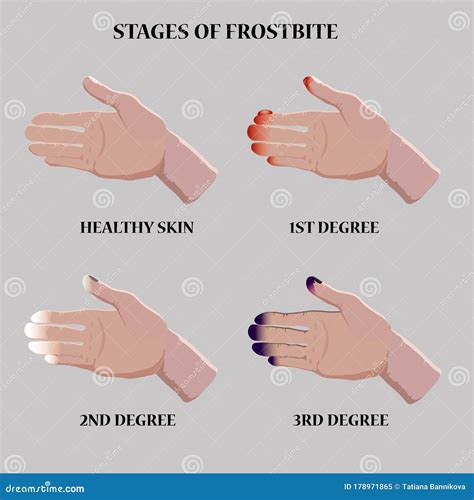 Cold And Flu Stages And Treatment Set. Royalty-Free Illustration | CartoonDealer.com #83340855
