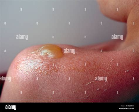 Close up of a severe second degree sunburn blister Stock Photo - Alamy