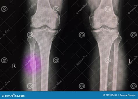 Proximal Fibula Fracture