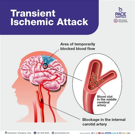 Brain Stroke: Types, Causes, Symptoms, Prevention & Treatment