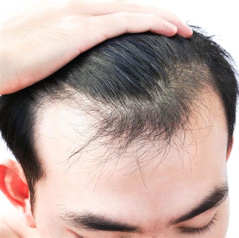 Stress and Hair Loss: What to Do Against It - Cosmedica Clinic
