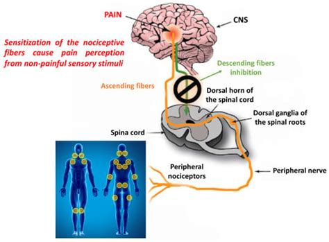 Fibromyalgia: Pathogenesis, Mechanisms, Diagnosis and Treatment Options ...