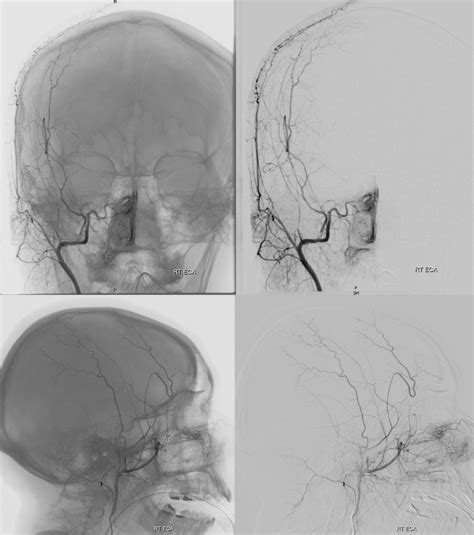 Trauma Direct Cavernous Carotid Fistula Multiple Sinus Compartments | neuroangio.org