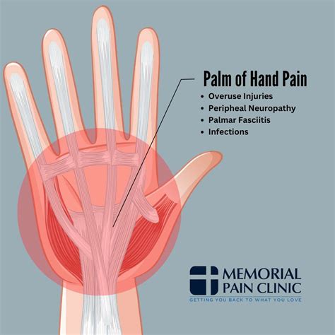 Hand Pain Diagram | Memorial Pain Clinic | Tulsa, OK