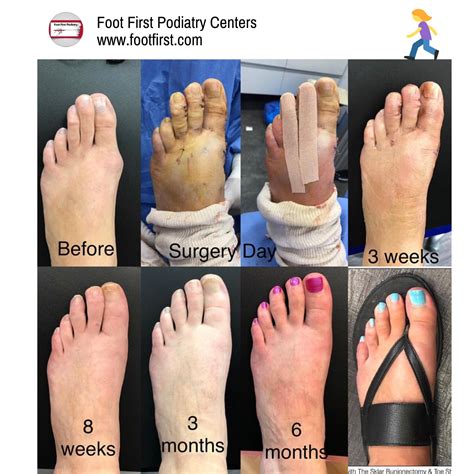 Mallet Toe Before And After