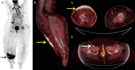 Image result for Sarcoma Staging