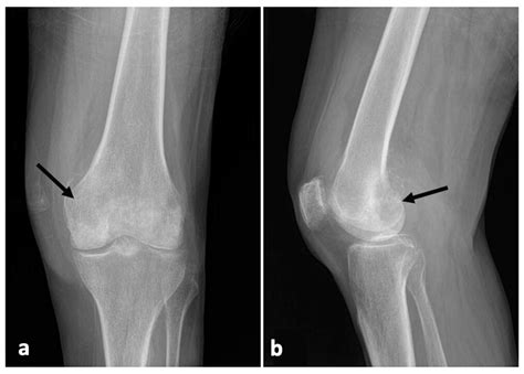 Malignant Knee Joint Effusion—A New Dimension of Laboratory Diagnostics