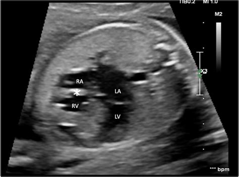 A Rare Case of Tricuspid Atresia Absent Pulmonary Valve Diagnosed on Fetal Echocardiography - CASE