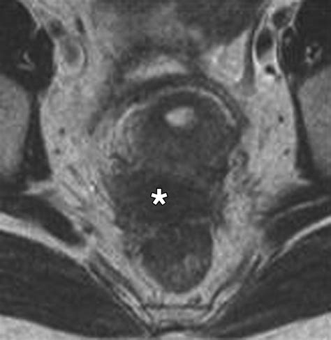 Endometriosis of the Posterior Cul-De-Sac: Clinical Presentation and ...
