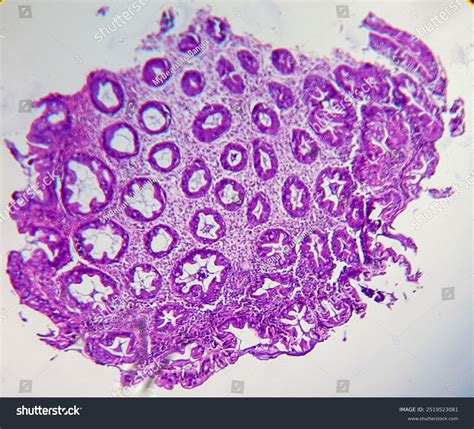 Tubular Adenoma Low-grade Dysplasia Colon Polyp Stock Photo 2519523081 ...