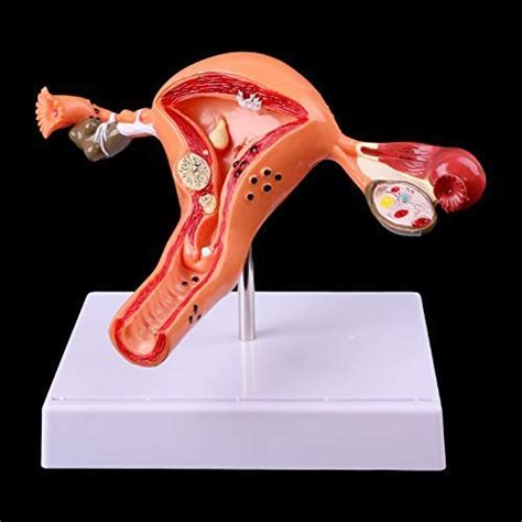 Buy YZ-YUAN Assembly Pathological Uterus Ovary Anatomical Model Anatomy ...
