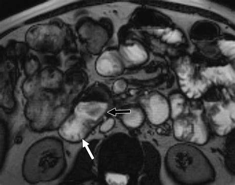 Duodenal Abnormalities at MR Small-Bowel Follow-Through | AJR