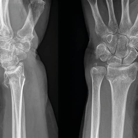 Die Behandlung distaler Radiusfrakturen im Alter – eine fast tägliche ...